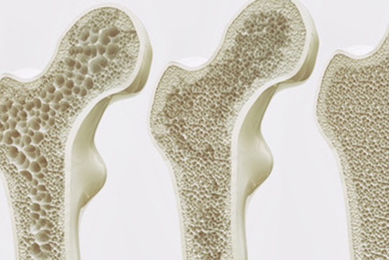 Giornata dell'osteoporosi | Farmacia Gamba